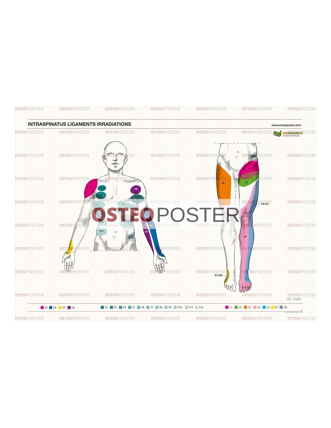 Osteoposter - Interspinous Ligament Irradiation - Front